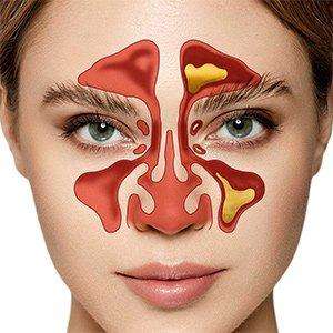 Akut Sinüzit ve Üst Solunum Yolu Enfeksiyonlarında Doğru Tedavi Nasıl Olmalı?