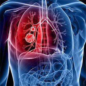 Pnömoni (Zatürre) Nedir? Tanısı, Tedavisi ve Erken Başvurunun Önemi