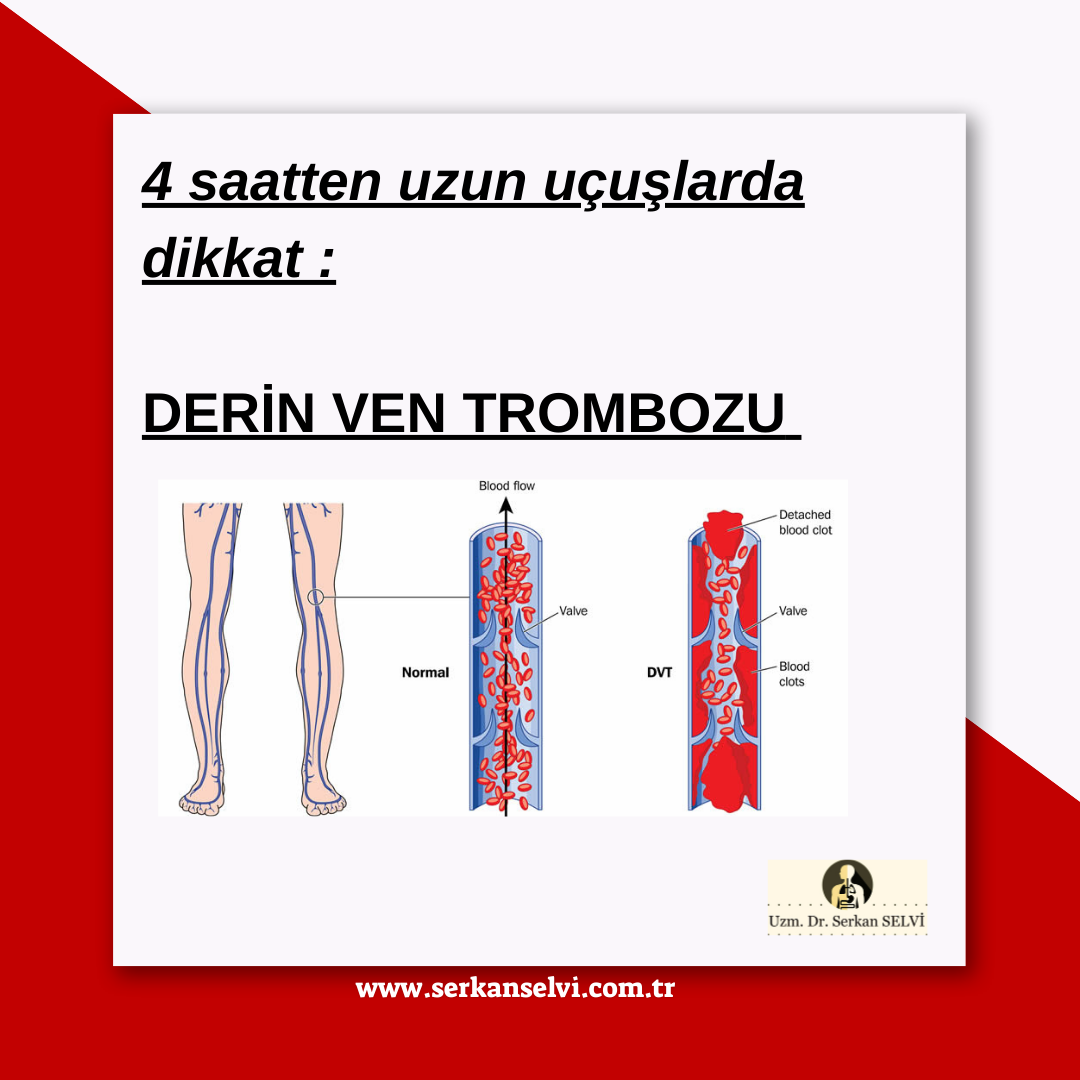 Uzun uçuşlar Derin Ven Trombozu riskini artırır mı ?